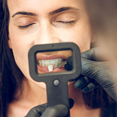 Lamina Veneers-Dental Clinic