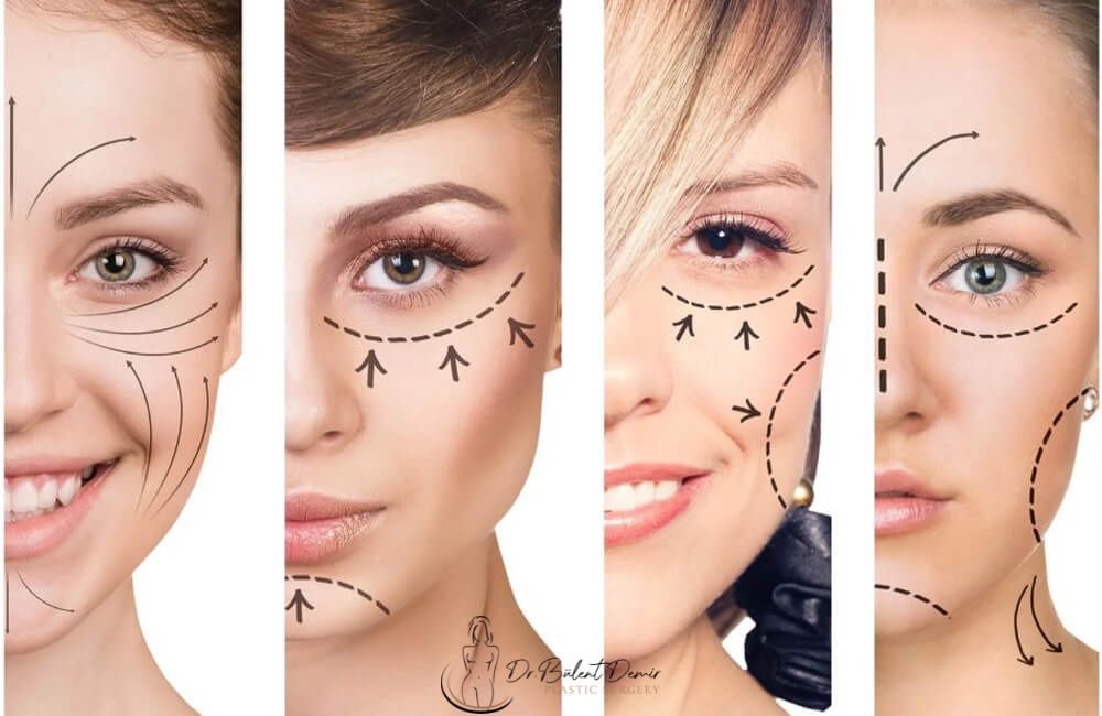 Endoscopic Face Lift in turkey Antalya