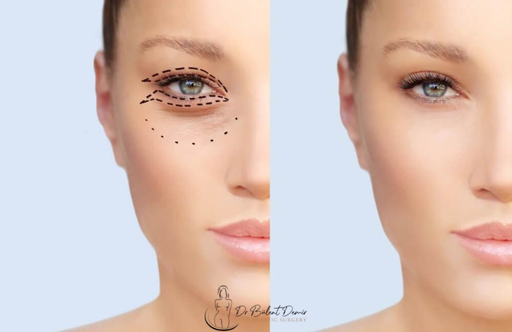 Eyelid lift in turkey Antalya