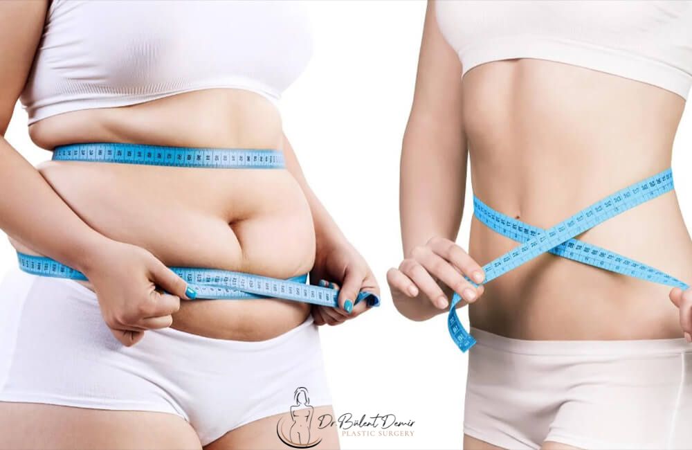 liposuction