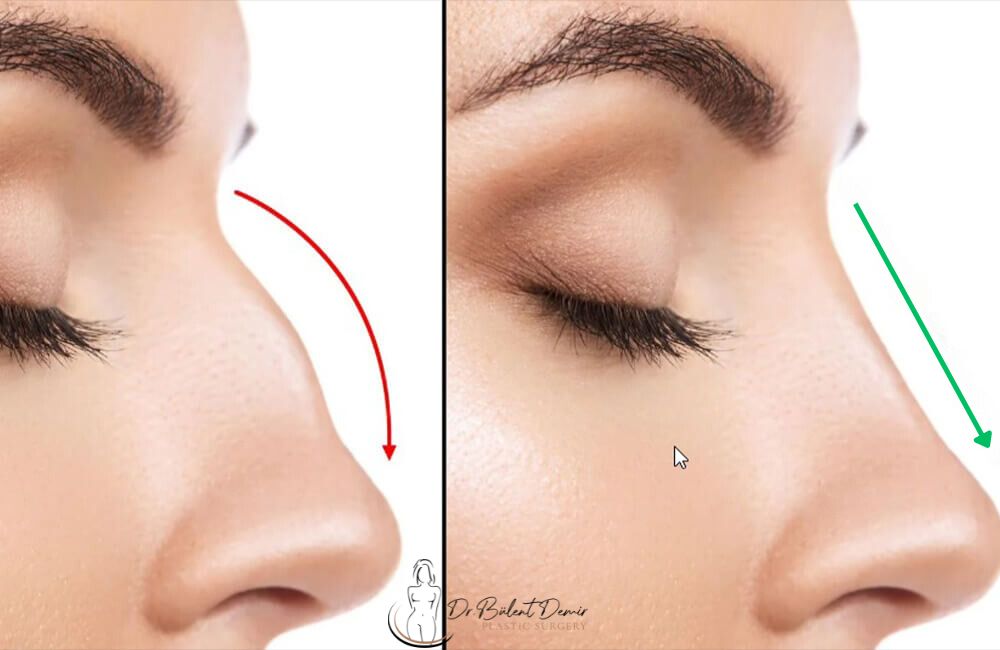 Rhinoplasty (Nose Job, Rhino), Nose Job Cost in Turkey