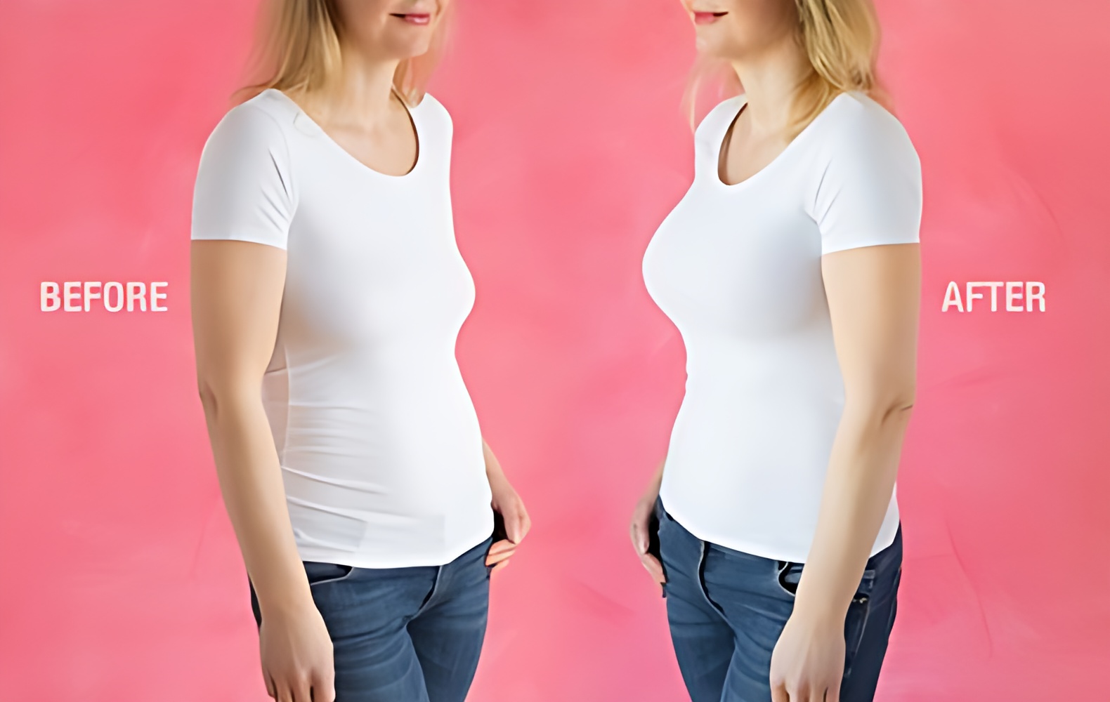 Breast lift-mastopexy before-after Turkey, nAntalya