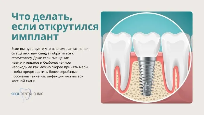 Что делать, если открутился имплант