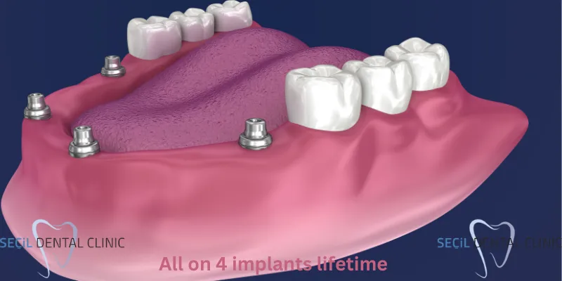 All on 4 Implant Lifetime