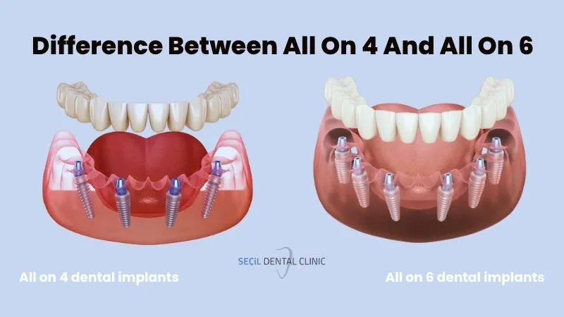 Between All On 4 And All On 6