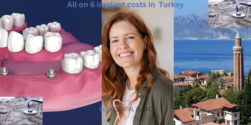 All on 6 Implant Costs in Antalya, Turkey