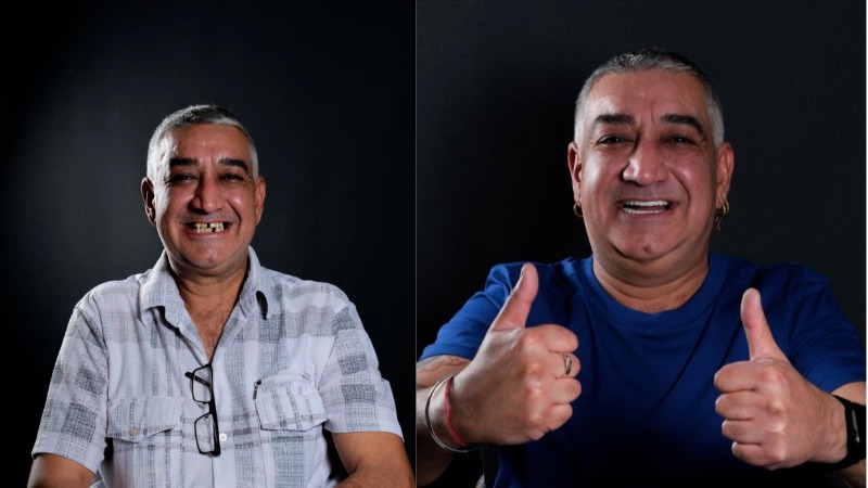 All on 6 implants in Antalya