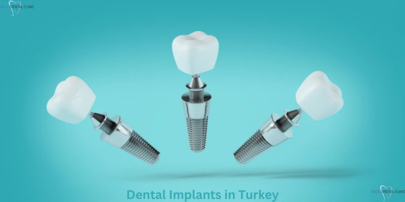 Dental Implants in Antalya, Turkey