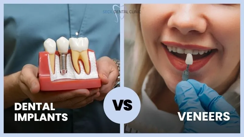 Dental Implants Vs Veneers