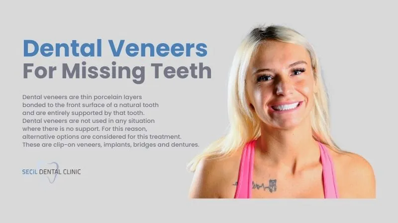 Dental veneers for missing teeth