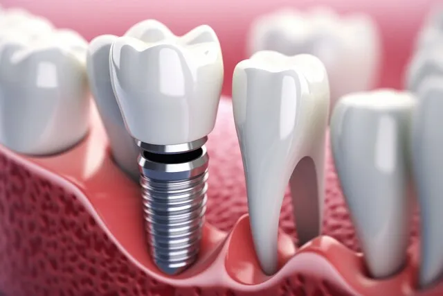 Different Types of Dental Implants