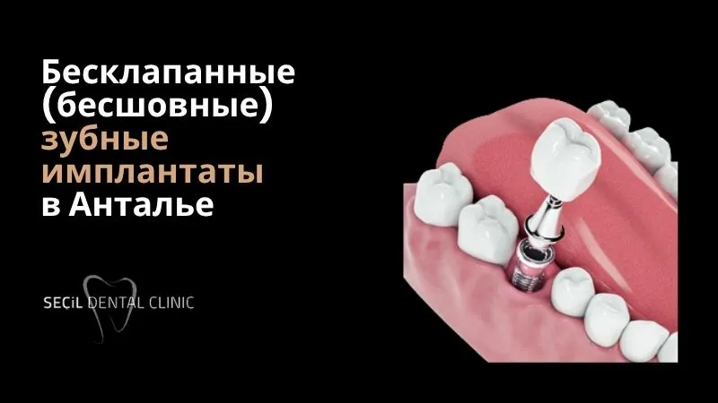 Бесклапанные (бесшовные) зубные имплантаты в Анталье
