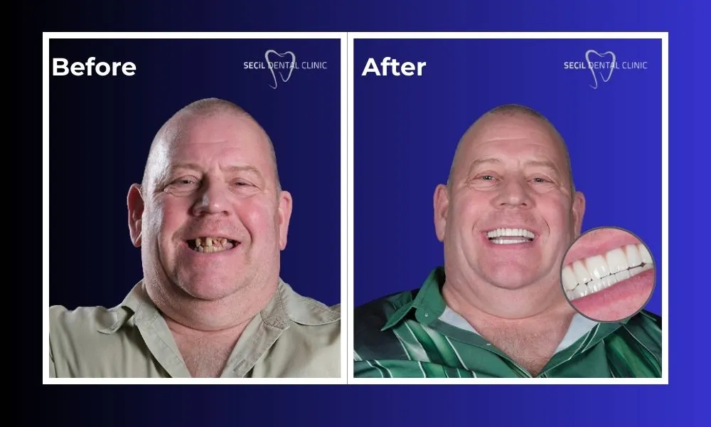 How many implants are needed for upper denture?