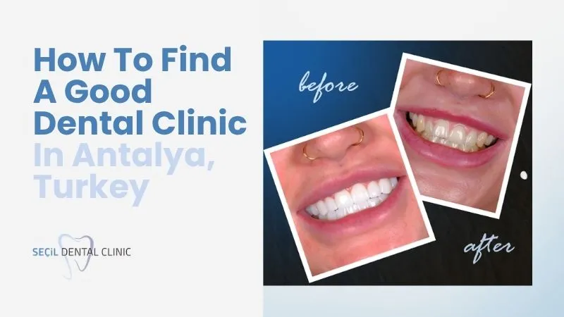 How to find a good dental clinic in Antalya​