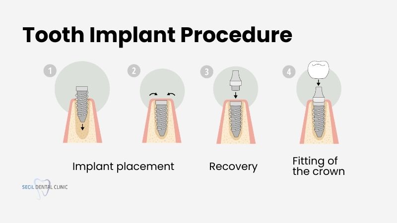 Tooth implant procedure: How long does it take
