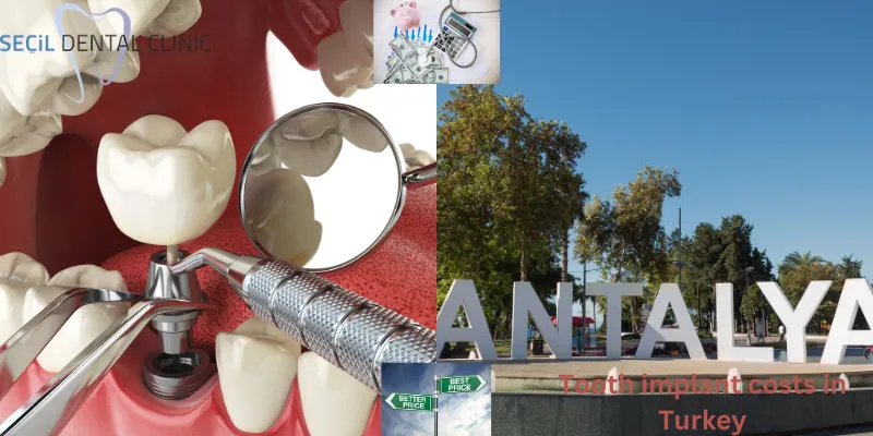 Tooth Implant Costs in Antalya, Turkey