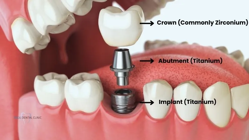 What are Dental Implants Made of?
