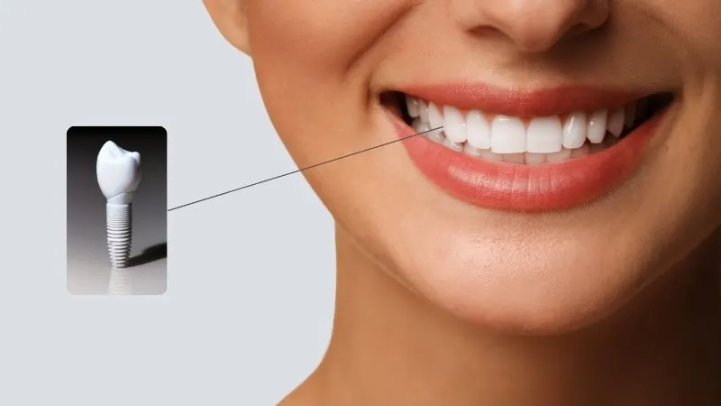 Zirconia Dental Implants Antalya
