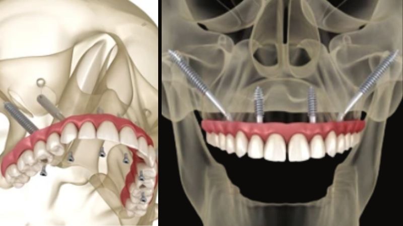 Zygomatic Implants