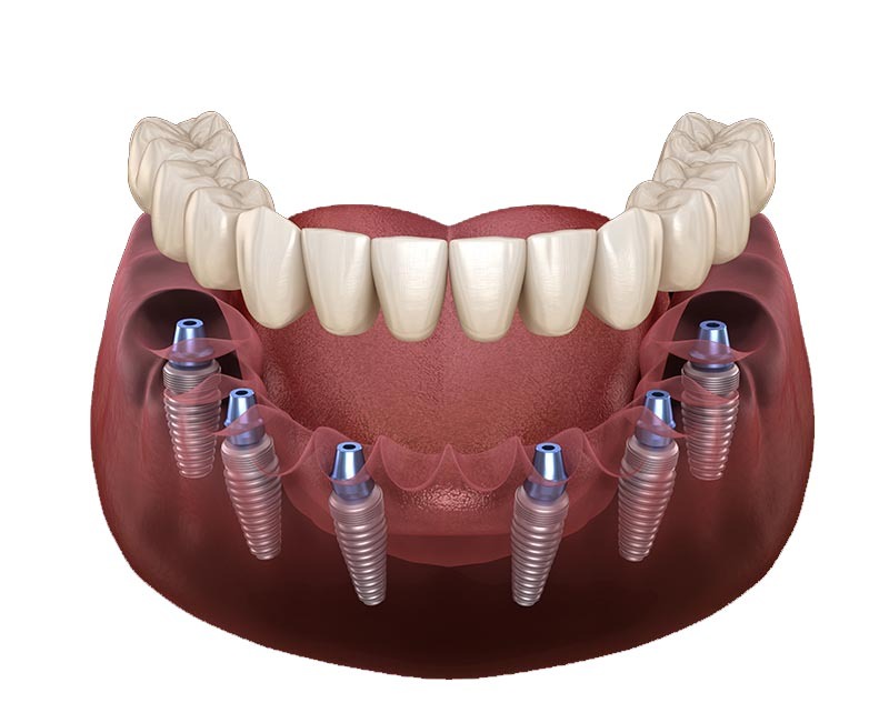 All On Six Dental Implants Turkey