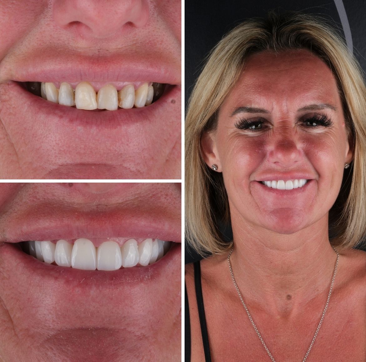 All On 4 Dental Implants Turkey