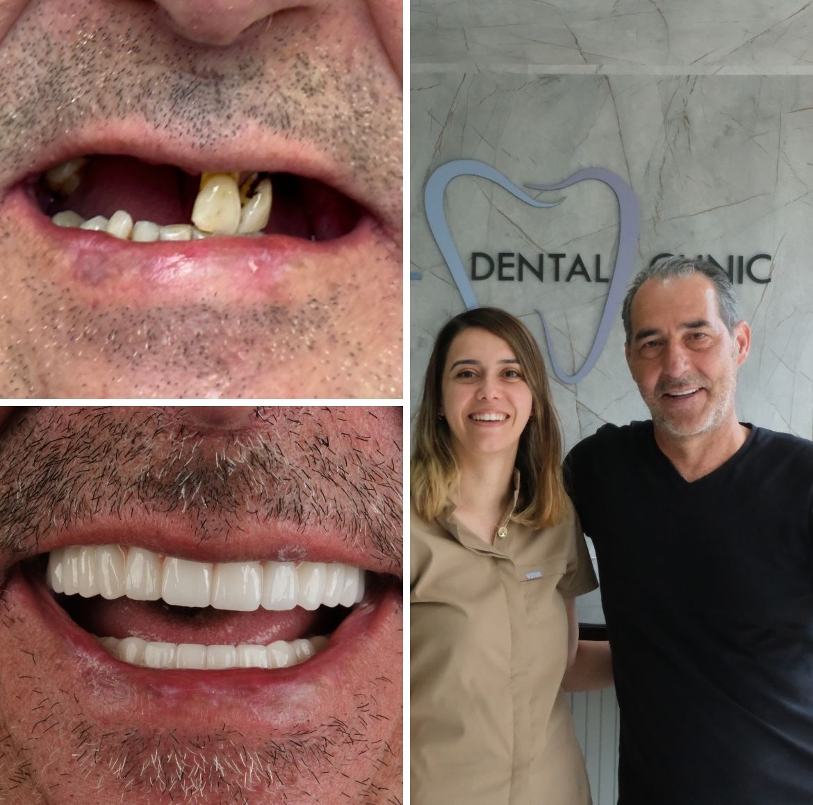 All On Four Dental Implants Turkey