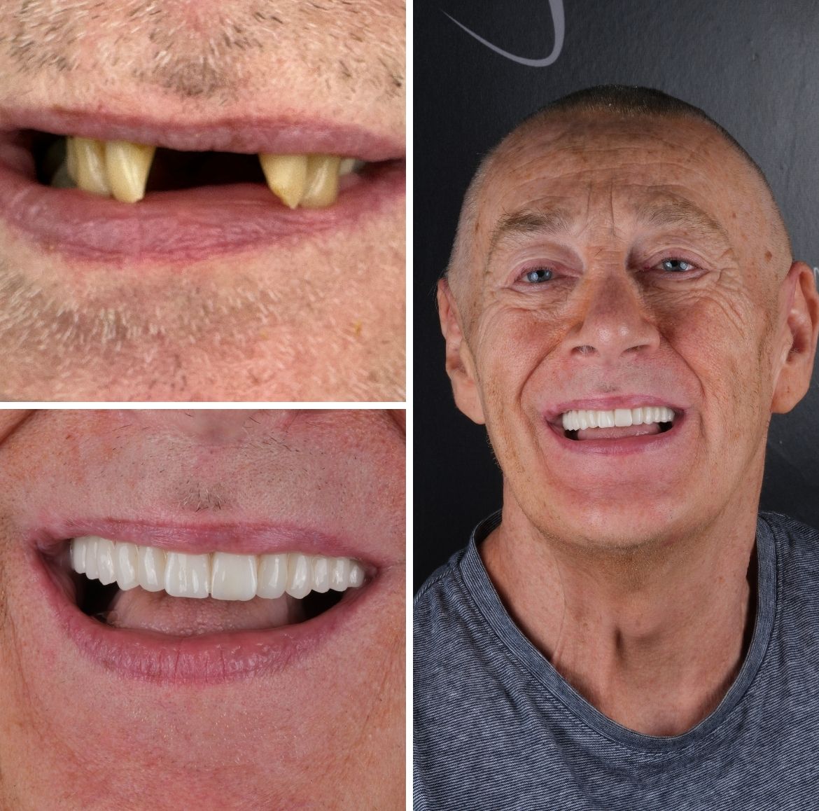 All On 4 Dental Implants Turkey