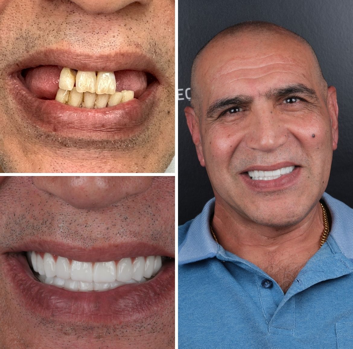 All On 4 Dental Implants Turkey