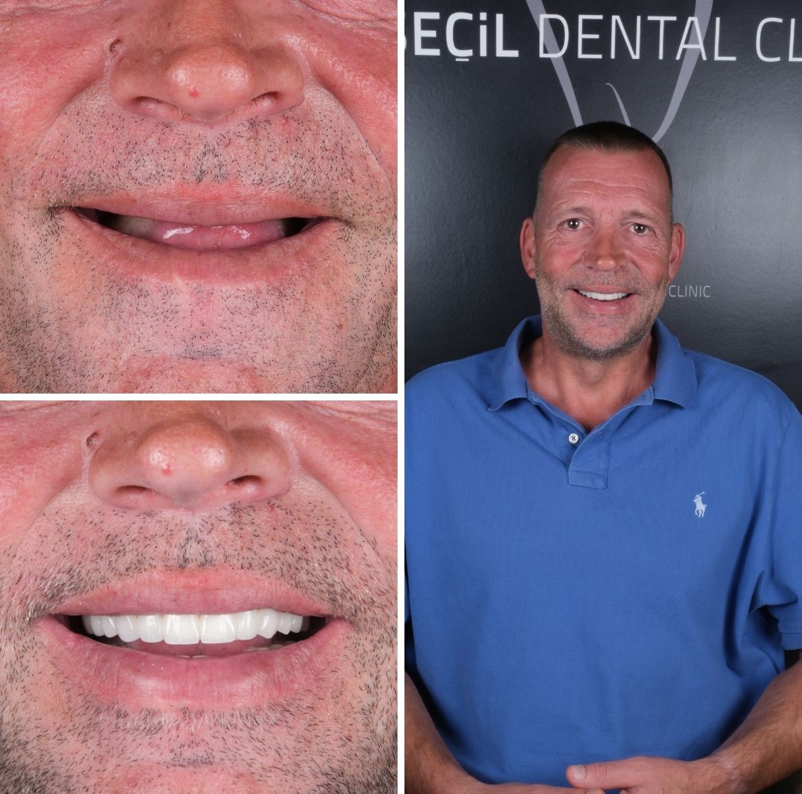All On Four Dental Implants Turkey