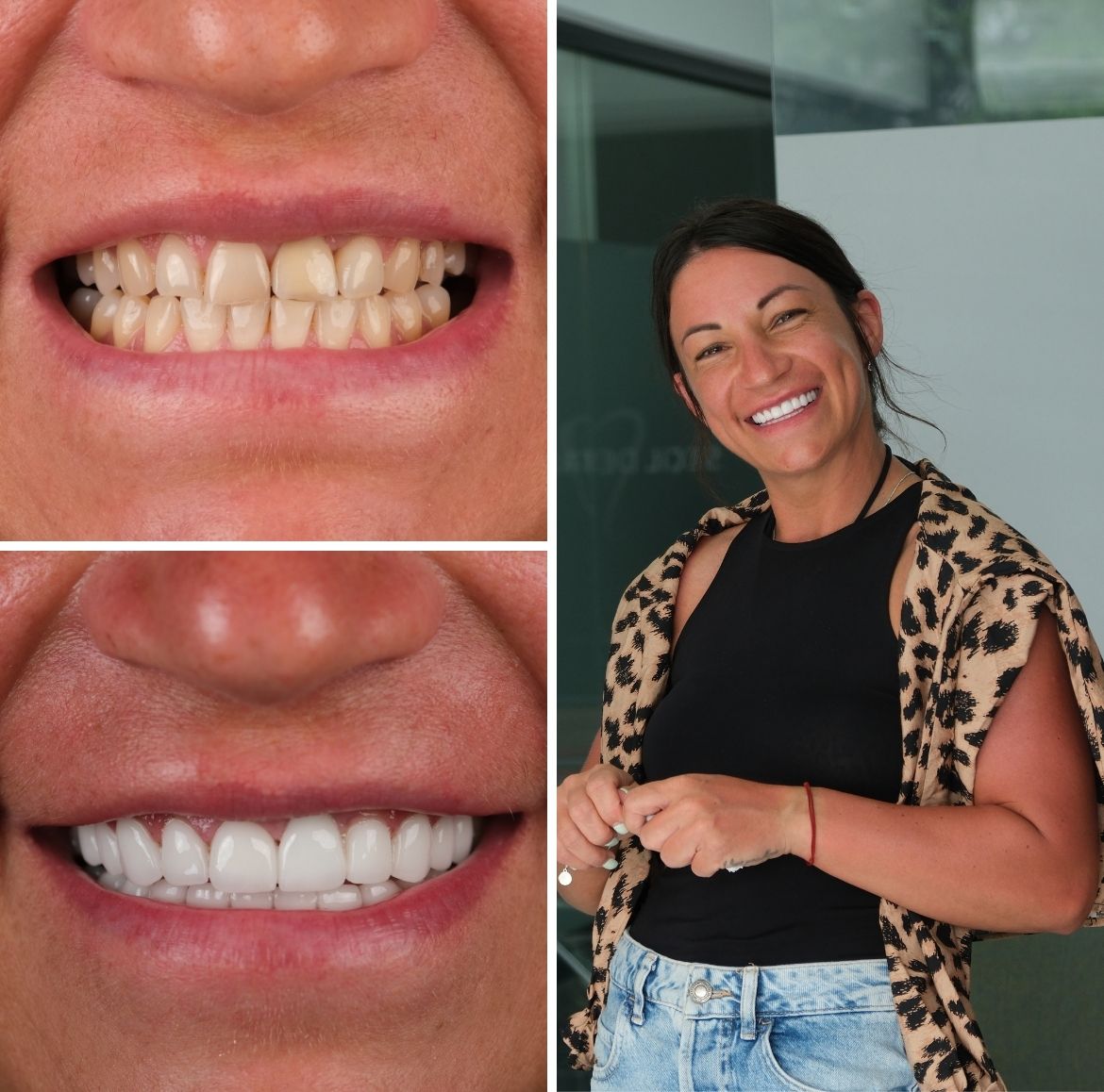 All On 4 Dental Implants Antalya