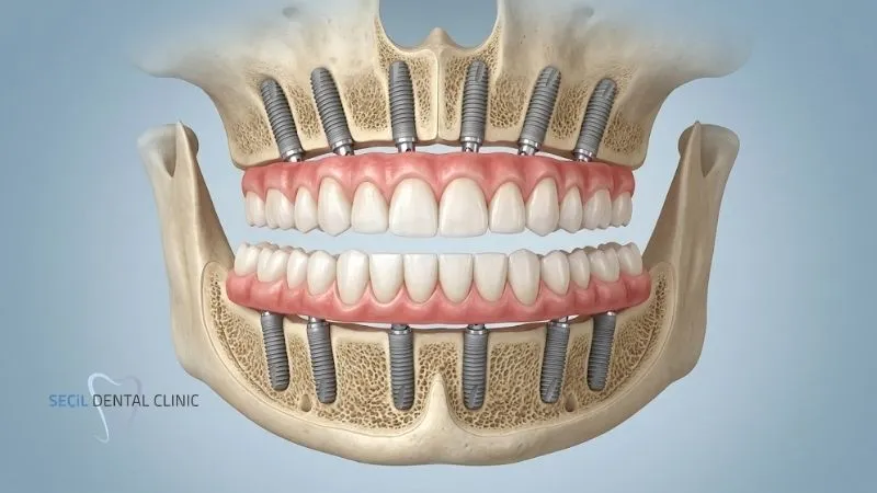 Antalya All On six dental implants