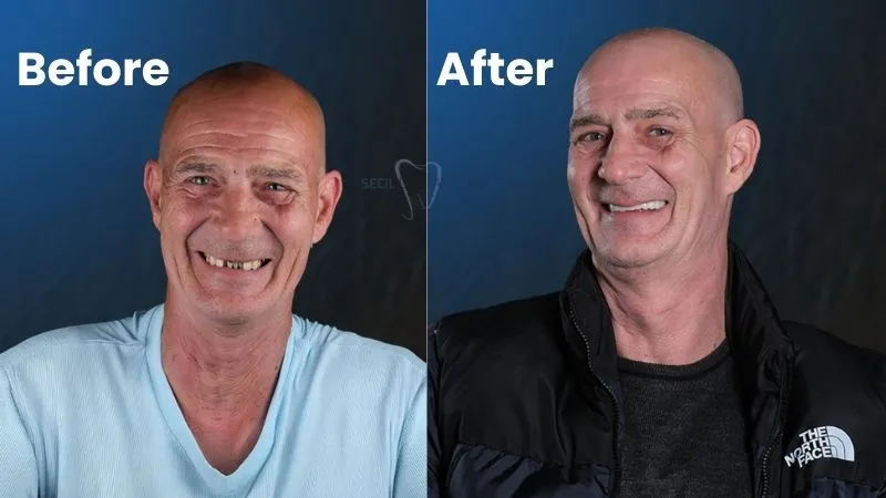 All On 6 Dental Implants