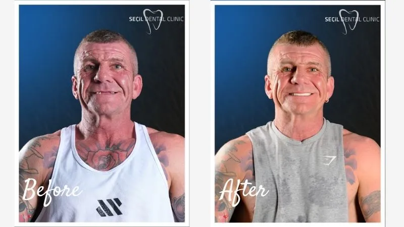 All On 6 Dental Implants