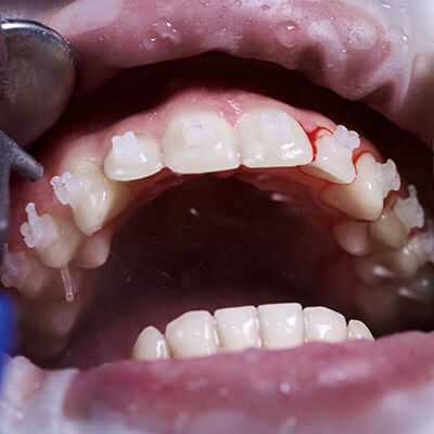 Teeth Stone Cleaning-dental-clinic