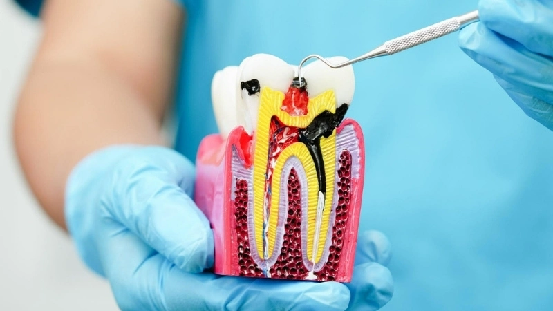 Antalya Kanal Tedavisi (Endodonti), Antalya Kanal Tedavisi Fiyatları