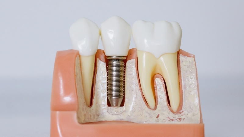 İmplant Diş Tedavisi Antalya