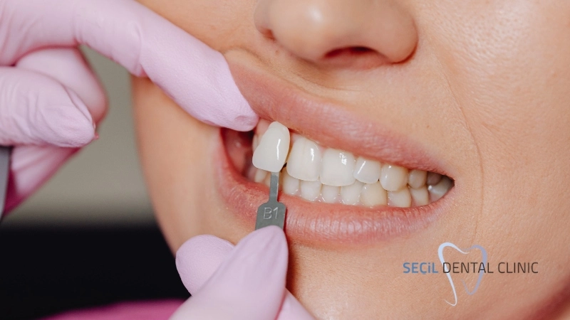 Lamine Diş Kaplama (Yaprak Porselen Diş) Antalya Lamine Diş Kaplama, Yaprak Porselen Diş