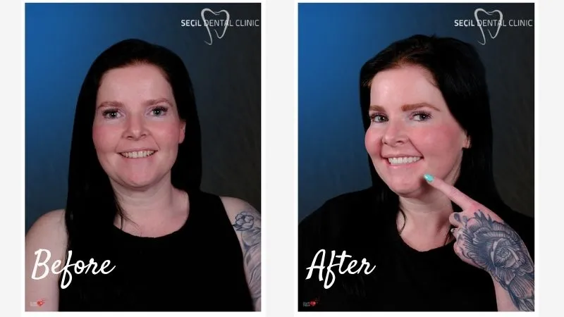 Smile Makeover Antalya
